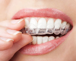 Invisalign Can Help Your Smile In More Ways Than One
