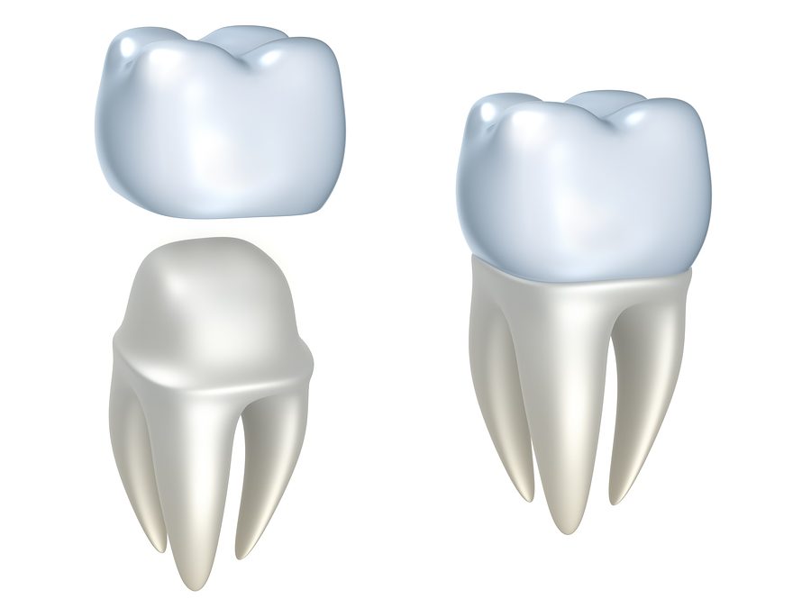 Restore Your Smile with CEREC Crowns